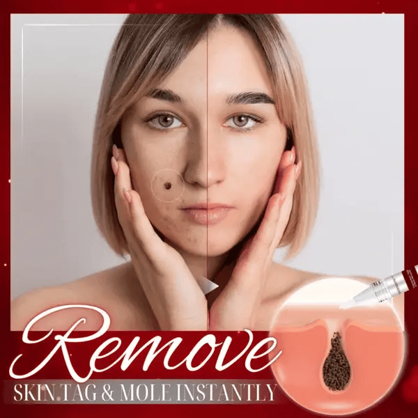 Women Idol™ Pigmaclean Tags & Mole Remover